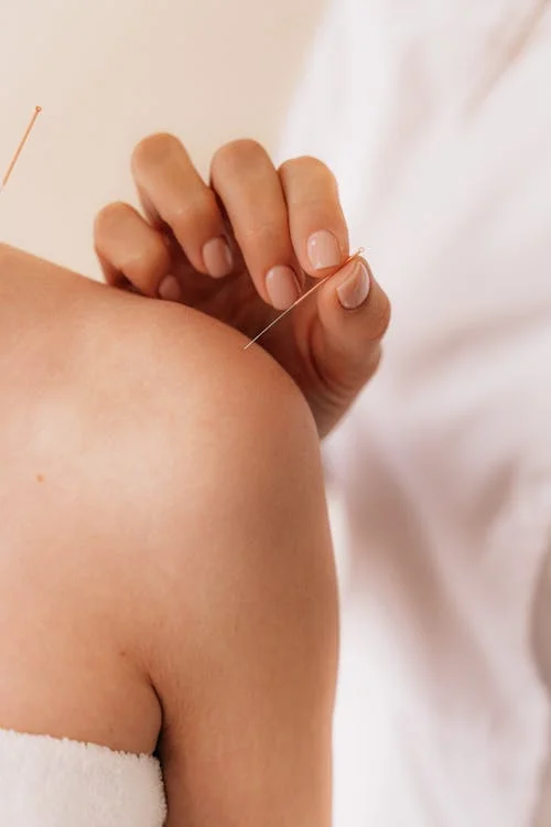 Acupuncture treatment